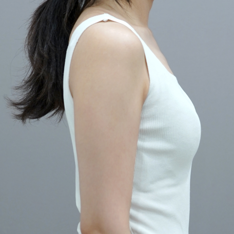 온다리프팅 바디라인 시술 직후 1 모바일