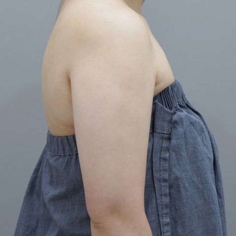 온다리프팅 바디라인 시술 직후 2 모바일