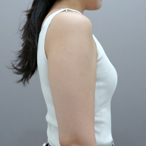 온다리프팅 바디라인 시술 전 1 모바일