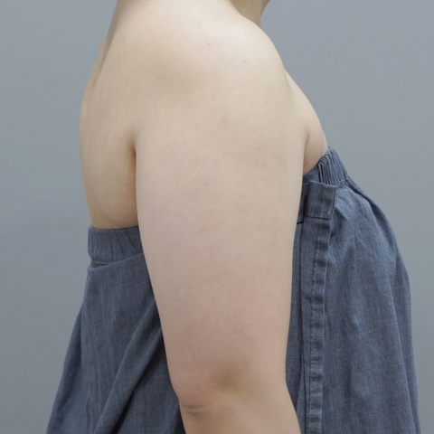 온다리프팅 바디라인 시술 전 2 모바일