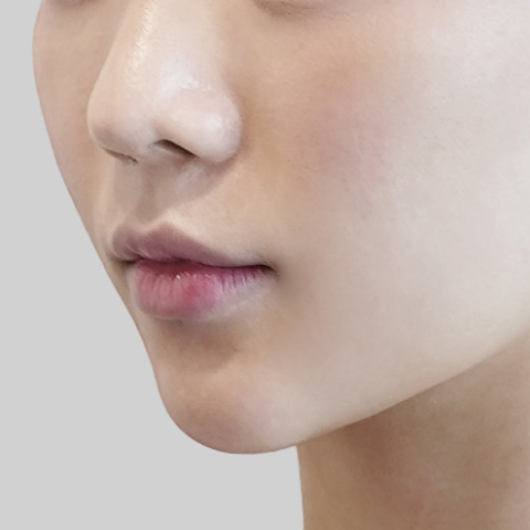 온다리프팅 페이스라인 시술 직후 2 모바일