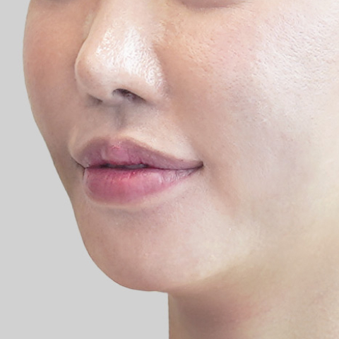 온다리프팅 페이스라인 시술 직후 3 모바일