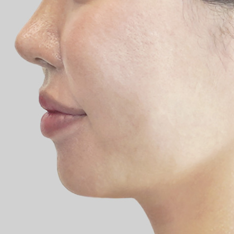 온다리프팅 페이스라인 시술 직후 4 모바일