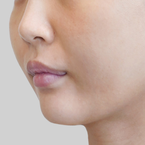 온다리프팅 페이스라인 시술 전 1 모바일