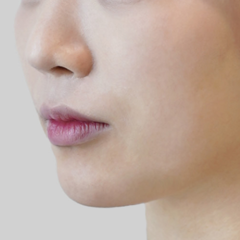 온다리프팅 페이스라인 시술 전 2 모바일