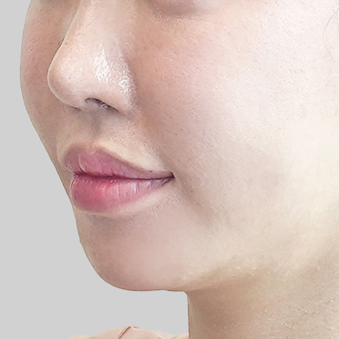 온다리프팅 페이스라인 시술 전 3 모바일