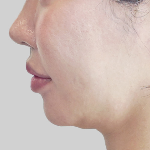 온다리프팅 페이스라인 시술 전 4 모바일