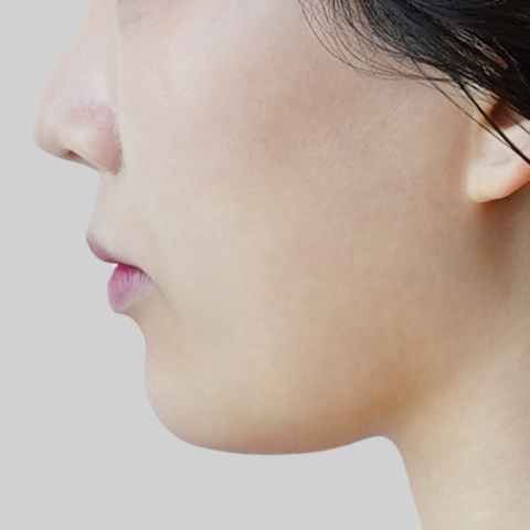 온다리프팅 페이스라인 시술 전 5 모바일