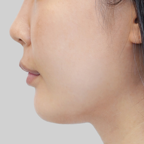 온다리프팅 페이스라인 시술 전 6 모바일