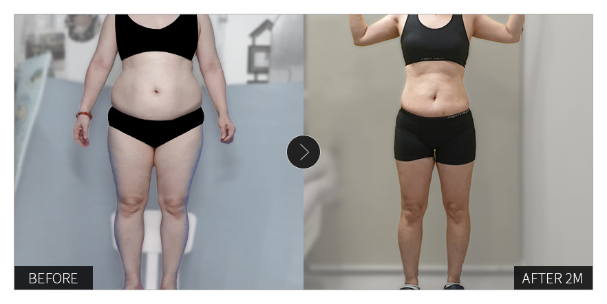 리엔장 1인치플러스 시술 전후 사진 01