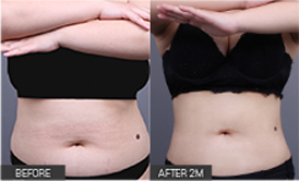 리엔장 1인치플러스 시술 전후 사진 03