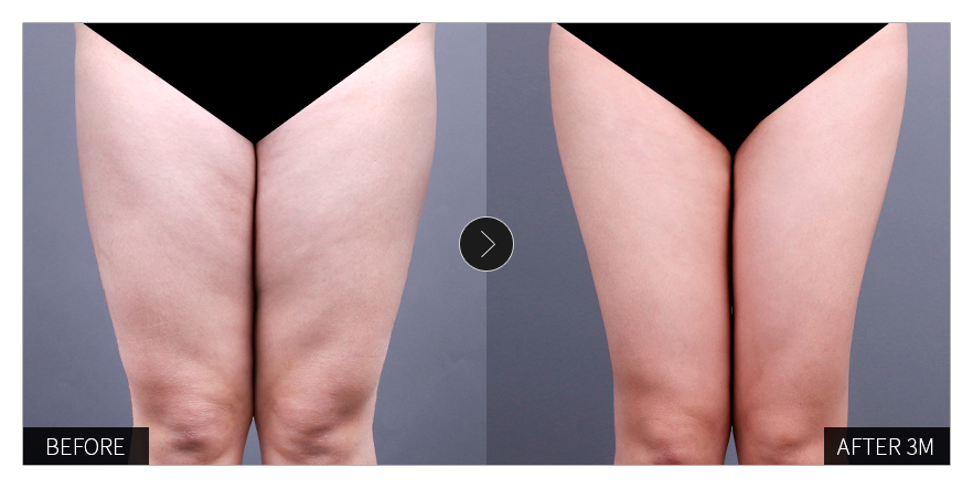 리엔장 1인치플러스 시술 전후 사진 06