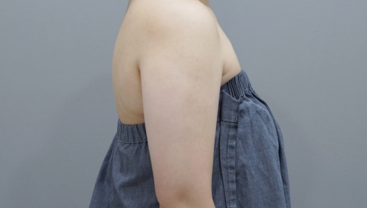 온다리프팅 바디라인 시술 직후 2