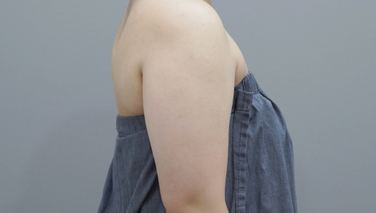 온다리프팅 바디라인 시술 전 2