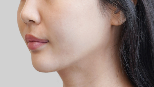 온다리프팅 페이스라인 시술 직후 1