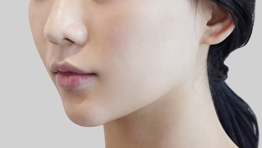 온다리프팅 페이스라인 시술 직후 2