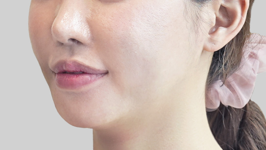 온다리프팅 페이스라인 시술 직후 3