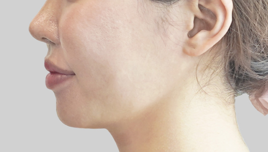 온다리프팅 페이스라인 시술 직후 4