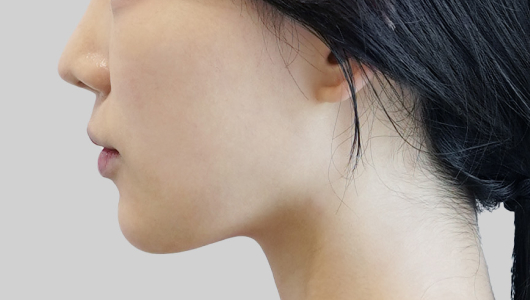 온다리프팅 페이스라인 시술 직후 5