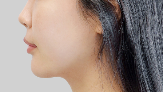 온다리프팅 페이스라인 시술 전 6 모바일