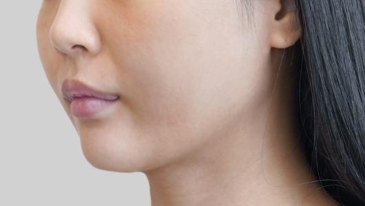 온다리프팅 페이스라인 시술 전 1