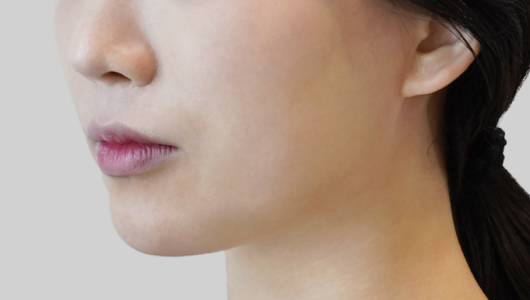 온다리프팅 페이스라인 시술 전 2