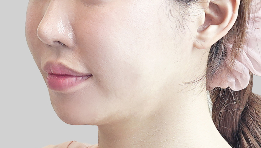 온다리프팅 페이스라인 시술 전 3