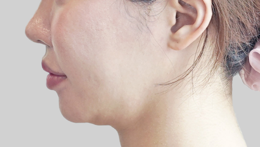 온다리프팅 페이스라인 시술 전 4