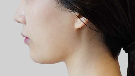 온다리프팅 페이스라인 시술 전 5