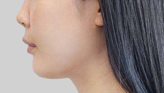 온다리프팅 페이스라인 시술 전 6