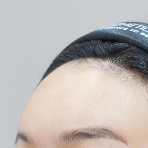 리엔장 이마필러 시술 직후 사진01 모바일