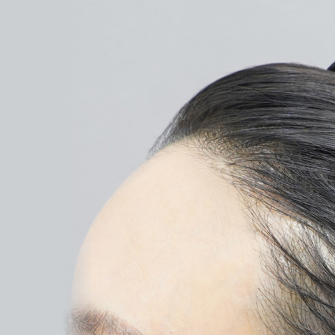 리엔장 이마필러 시술 직후 사진02 모바일