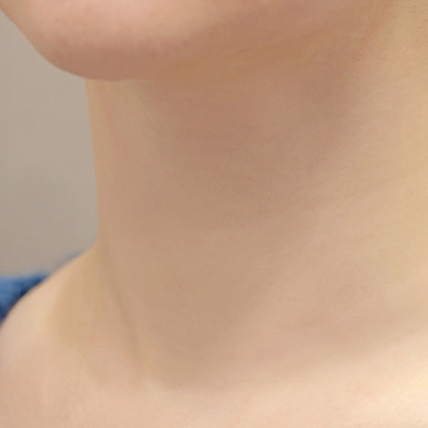 리엔장 목주름 필러 시술 직후 사진 모바일