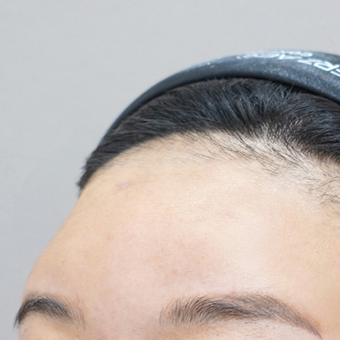 리엔장 이마필러 시술 전 사진01 모바일