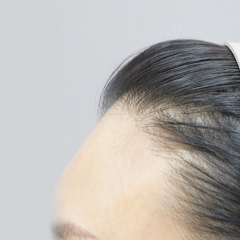 리엔장 이마필러 시술 전 사진02 모바일