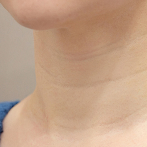 리엔장 목주름 필러 시술 전 사진 모바일