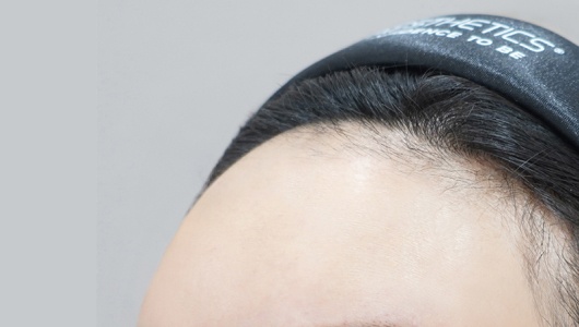 리엔장 이마필러 시술 직후 사진01