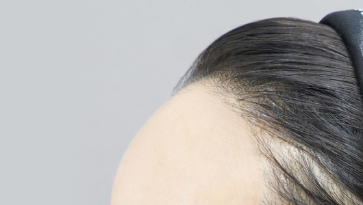 리엔장 이마필러 시술 직후 사진02