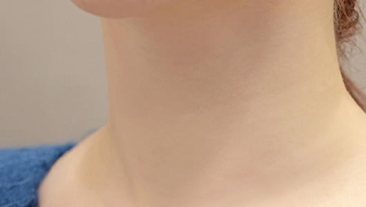 리엔장 목주름 필러 시술 직후 사진