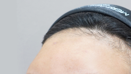 리엔장 이마필러 시술 전 사진01