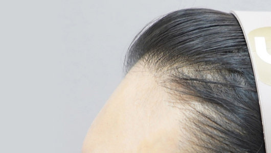 리엔장 이마필러 시술 전 사진02