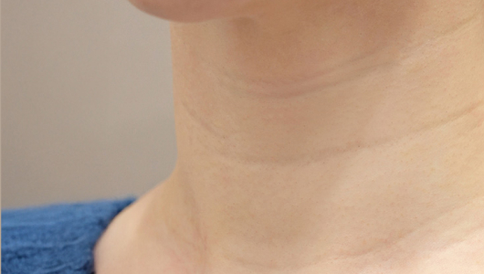 리엔장 목주름 필러 시술 전 사진