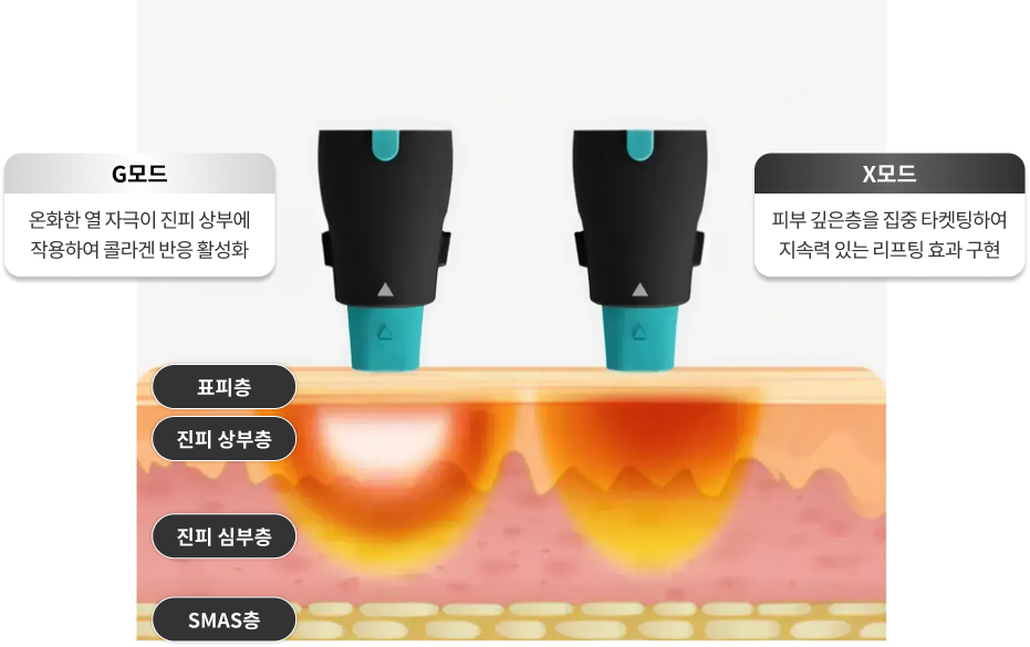 올리지오Kiss 고주파 혁신적 듀얼모드: 진피 상하부 동시 타깃 인포그래픽