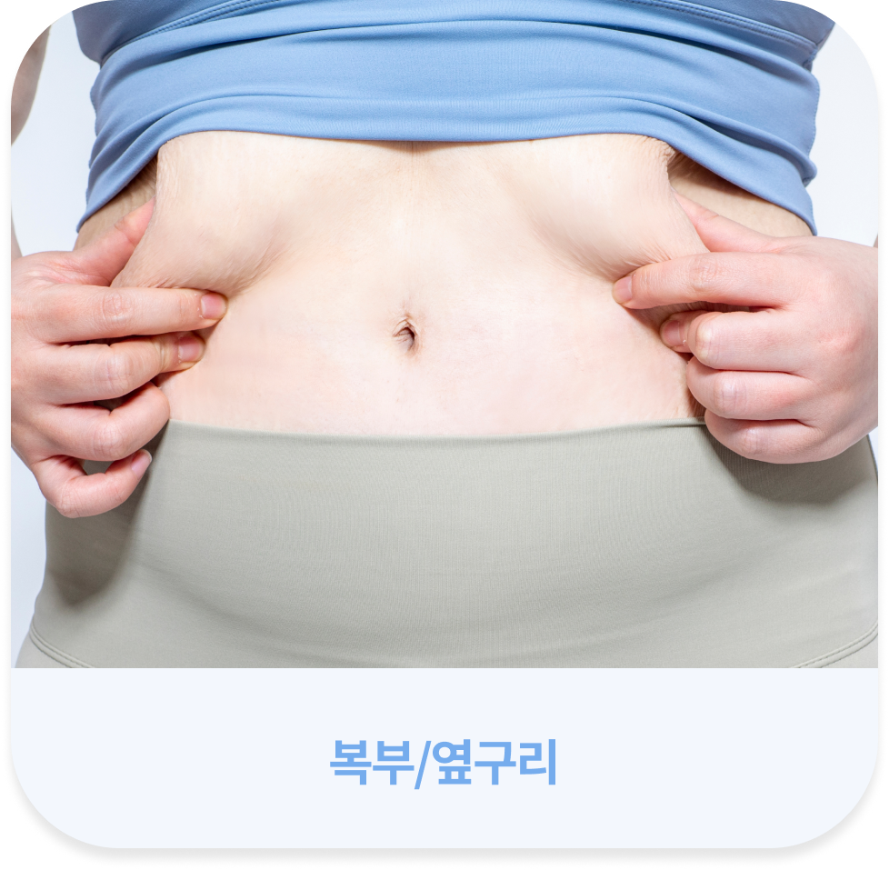 살빼주사 시술 부위 안내 모바일 허벅지